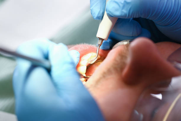 Best Emergency Wisdom Teeth Removal in Bethel, NC
