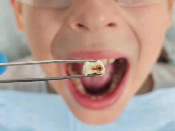 Best Emergency Tooth Extraction in Bethel, NC